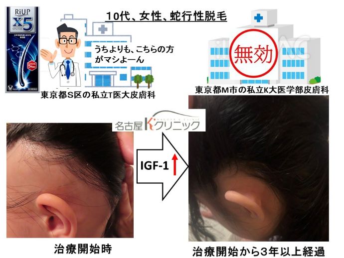 円形脱毛症　病院